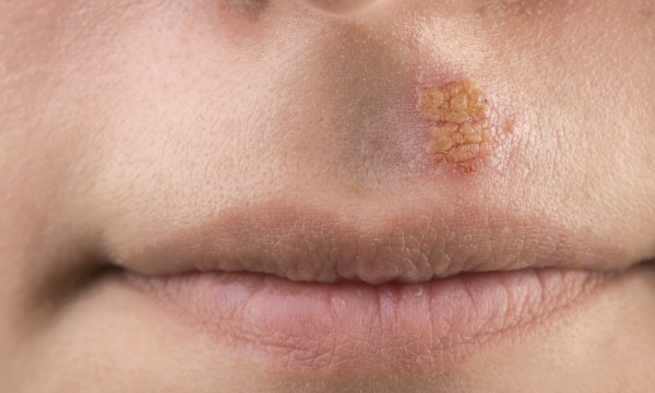 Why Do I Get Cold Sores So Often Smart Tips