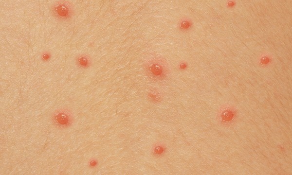 Helpful hints for identifying spots and rashes