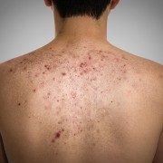 Do you want to know how to get rid of acne scars on the back?
