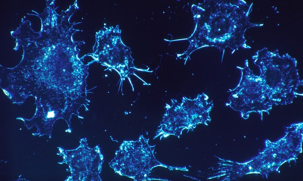 5 new options for treating prostate cancer