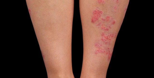 Quest utile pour le psoriasis